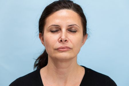 revitalizing before after
